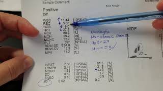 Hematology How to interpret automated Complete Blood Count CBC results [upl. by Eilram153]