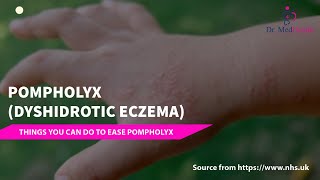 Pompholyx  Dyshidrotic eczema  dyshidrotic eczema treatment [upl. by Anaej116]