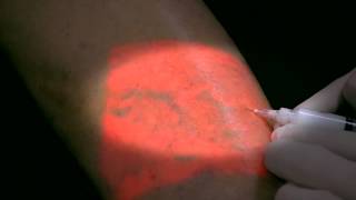 AccuVein Foam Sclerotherapy [upl. by Marsland]