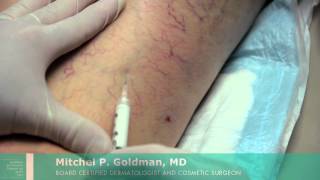 Sclerotherapy For Leg Veins  Mitchel P Goldman MD  San Diego [upl. by Rancell672]