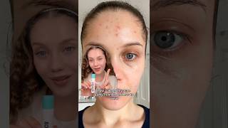 GET RID OF ACNE⁉️ USING TRETINOIN💕 skin acne skincaretips acnetreatment tretinoin retinoids [upl. by Wehttan435]