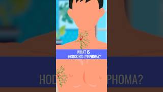 What is HODGKINS LYMPHOMA [upl. by Jamila784]