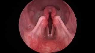 Dog Lar Par Laryngeal paralysis observed in sedated canine oral exam [upl. by Jea]