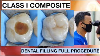 Dental Filling Full Procedure Class I Composite  General Dentist Griya RR [upl. by Yatnwahs591]