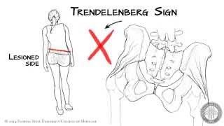 The Trendelenberg Sign HD [upl. by Barby]