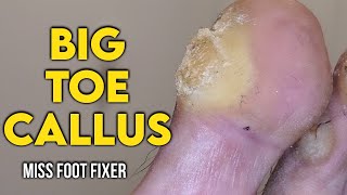 SHAVING OF REAL BIG TOE CALLUS 🦶 BIGGEST TOE CALLOUS EVER FULL TREATMENT BY MISS FOOT FIXER [upl. by Lemmuela903]