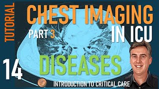 Chest Imaging in ICU  Part 3  Diseases of the Lung in ICU [upl. by Lawlor407]