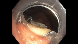 Full Thickness Resection of Appendiceal Orifice using Ovesco FTRD [upl. by Gwenni]