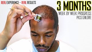 Microneedling Hair Regrowth Results 3 Months  Month by Month Progress [upl. by Ettennahs602]