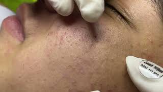 Acne treatment for Spa Linh Mun 2023 026 [upl. by Ottinger]