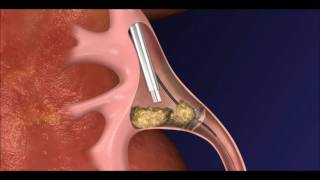 CoAx PCNL Antegrade Animation [upl. by Anelehs788]