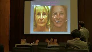 Optimizing Facelift Results–Volume  Laser Resurfacing [upl. by Albion]