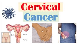 Cervical Cancer Risk Factors Pathophysiology Symptoms Staging Diagnosis Treatment amp Prevention [upl. by Sokin]