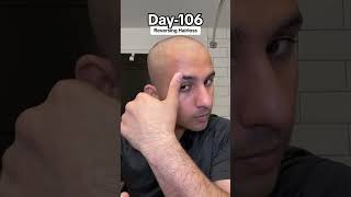 Day106 of to Reverse HairLoss bald minoxidil minoxidilresult hairloss hairgrowth [upl. by Sundstrom]