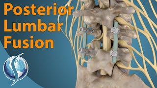 Posterior Lumbar Fusion [upl. by Ilera28]