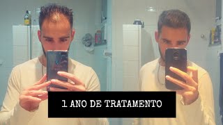 MINOXIDIL  FINASTERIDA 1 ANO DE TRATAMENTO [upl. by Heisel]