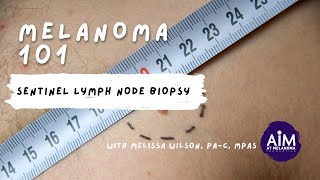 Sentinel Lymph Node Biopsy [upl. by Atirehc]