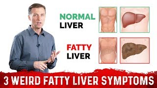 3 Weird Signs amp Symptoms Of Fatty Liver – DrBerg [upl. by Emilee]