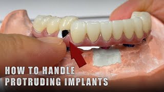 How to handle Protruding Implants [upl. by Thain]