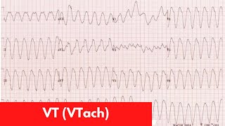 VT vs SVT with Aberrancy  For DO MD NP PA Part 6 [upl. by Llemrej491]