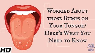 Worried About Those Bumps on Your Tongue Heres What You Need To Know [upl. by Ronacin236]