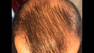 14 month’s using minoxidil  Rogaine 5 Before amp After results [upl. by Daggna]