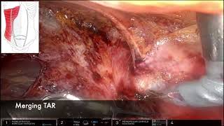 Robotic eTEP TAR with BTA injection for Complex and Loss of domain Ventral hernia Tips and Tricks [upl. by Lessirg]