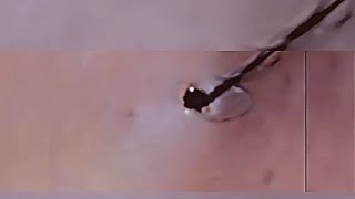 Removal of ingrown hair [upl. by Akimrehs106]