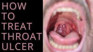 How to treat throat ulcer [upl. by Seitz567]