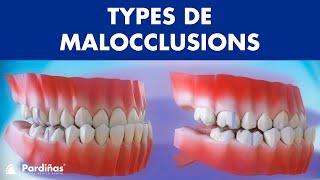 Malocclusion – Types de malocclusions dentaires © [upl. by Genvieve687]