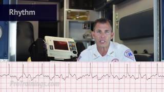 Atrial Fibrillation ECG Rhythm Interpretation [upl. by Muryh]