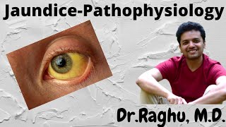 JAUNDICE  Types and Pathophysiology  Catabolism of Hemoglobin [upl. by Claudius]