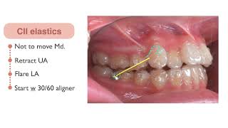 Excessive Overjet and Congenital Missing Teeth Treated with Clear Aligners｜【Chris Chang Ortho】CC673 [upl. by Niels]