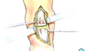 Malpractice Medical Achilles Tendon Repair Surgery 3 [upl. by Moulden]