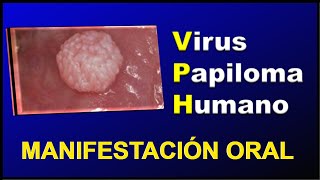 MANIFESTACIONES ORALES 𝐃𝐄𝐋 VIRUS 𝐃𝐄𝐋 PAPILOMA HUMANO VPH [upl. by Recnal]