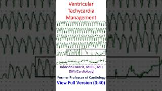 Ventricular Tachycardia Management [upl. by Eedebez]