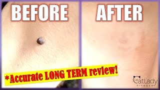 How to REMOVE A MOLE at home with Apple Cider Vinegar STEPBYSTEP DETAILS  Cat Lady Fitness [upl. by Chavaree87]