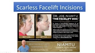 Facelift Incisions and Scars Dont Have Facelift Surgery Without Watching This [upl. by Aicekal]