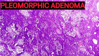 Benign Mixed Tumour of Salivary Gland  Pleomorphic Adenoma Histopathology [upl. by Llirret]