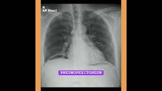 Pneumoperitoneum  XRay pneumoperitoneum meremehboob shilparao tseries xray triptidimri song [upl. by Still22]