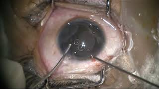 Triple treatment therapy for congenital stromal iris cyst [upl. by Estella]