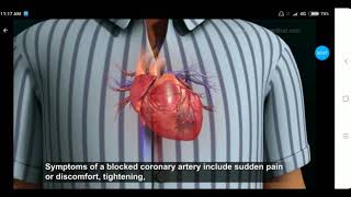 Myocardial Infarction in Hindi Part 2 by Dr Maulik Patel [upl. by Adnarrim]