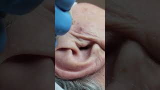 Seborrheic Keratosis Removal Philadelphia [upl. by Gusta]