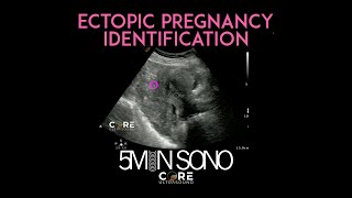 PointofCare Ultrasound for Ectopic Pregnancy Identification 5MS [upl. by Alica]