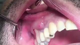 Popping a Tooth Abscess [upl. by Hailed]