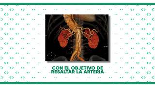 Angiotomografía de aorta [upl. by Cordle]