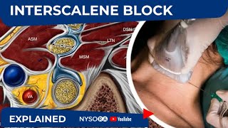 NYSORA Regional Anesthesia Interscalene Block [upl. by Bishop]