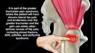 Gluteus Medius Tendon Tear  Everything You Need To Know  Dr Nabil Ebraheim [upl. by Armington]