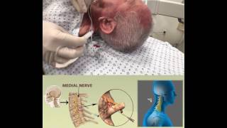 CERVICAL RADIOFREQUENCY ABLATION [upl. by Lacagnia]