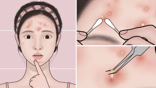 ASMR Acne Treatment At Home  Pimple Acne Removal Animation  Mengs Stop Motion [upl. by Alyt870]